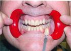 Best-Bleaching-Procedure-Ever-Devolped-Before-Image