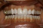 Upper-Porcelain-Veneers-and-Lower-Bleaching-After-Image