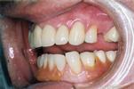 Full-Mouth-Reconstruction-Crowns-Bridework-Lower-Partial-After-Image