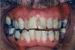 Full-Mouth-Reconstruction-Crowns-Bridework-Lower-Partial-Before-Image