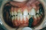 Porcelain-Crowns-to-Restore-Broken-and-Decayed-Teeth-Before-Image
