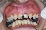 Porcelain-Crowns-to-Restore-Broken-and-Decayed-Teeth-Before-Image