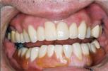 Full-Mouth-Reconstruction-Crowns-Bridework-Lower-Partial-After-Image
