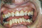 Porcelain-Crowns-to-Restore-Broken-and-Decayed-Teeth-After-Image