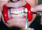 Best-Bleaching-Procedure-Ever-Devolped-After-Image
