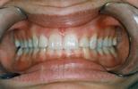 Upper-Porcelain-Veneers-and-Lower-Bleaching-Before-Image