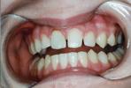 Porcelain-Crowns-to-Restore-Broken-and-Decayed-Teeth-After-Image